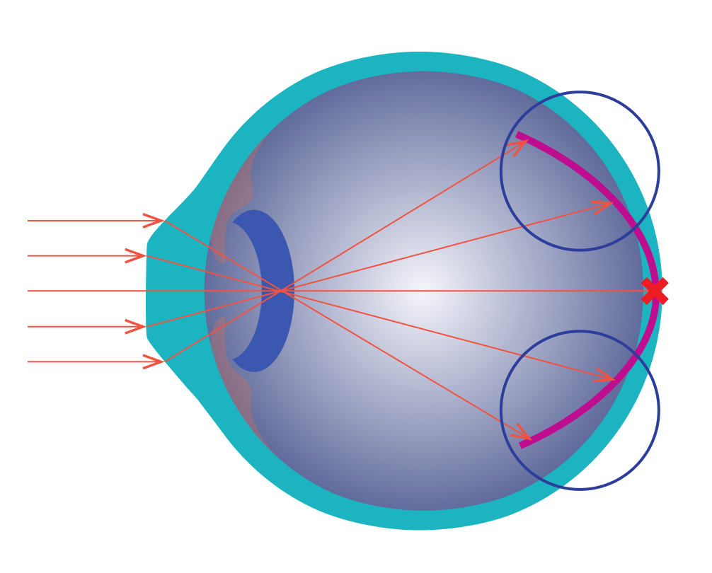 MoonLens